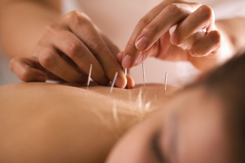 Cotton Tree Acupuncture - Treatment in Progress